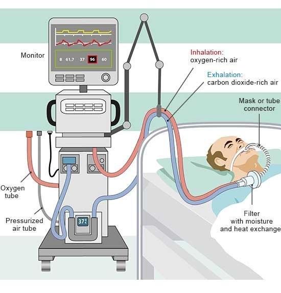Mechanical Ventilator